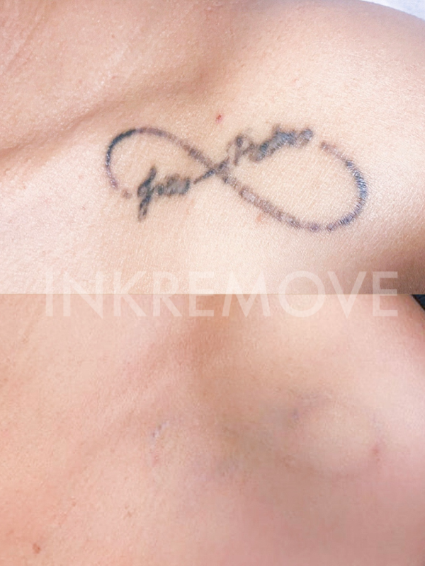 Remoção de Tatuagem