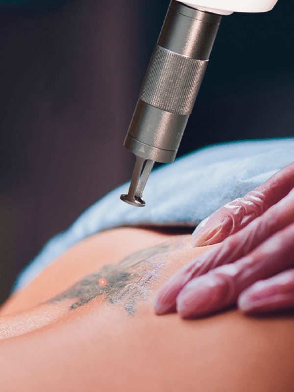inkremove+remoção+de+Tatuagem+Juazeiro+do+norte