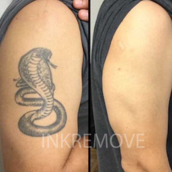 INKREMOVE