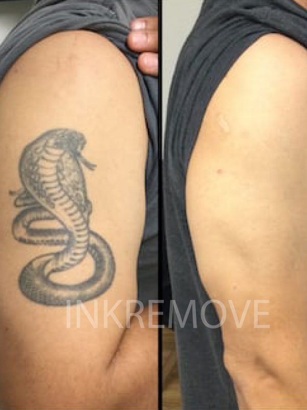 INKREMOVE