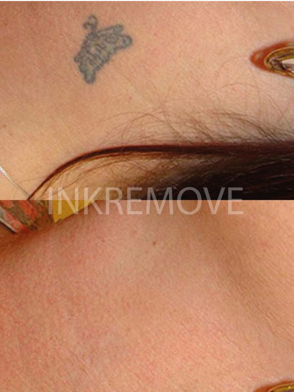 inkremove+remoção+de+Tatuagem+Juazeiro+do+norte8-01