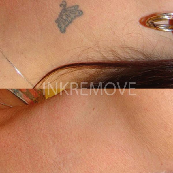 inkremove+remoção+de+Tatuagem+Juazeiro+do+norte8-01