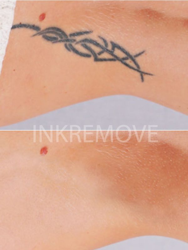 inkremove+remoção+de+Tatuagem+Juazeiro+do+norte9-01