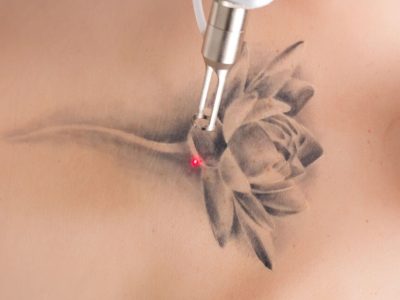 remocao de tatuagem 02
