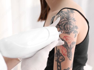 remocao+de+tatuagem+em+juazeiro+do+norte